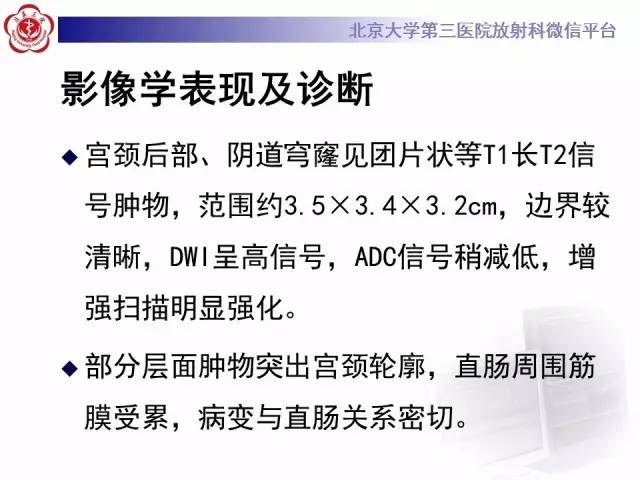【病例】宫颈子宫内膜异位症(深部浸润型)1例MR