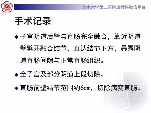 【病例】宫颈子宫内膜异位症(深部浸润型)1例MR
