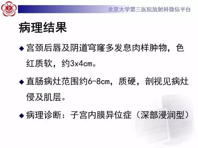 【病例】宫颈子宫内膜异位症(深部浸润型)1例MR