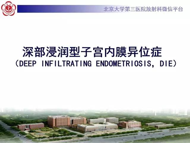 【病例】宫颈子宫内膜异位症(深部浸润型)1例MR