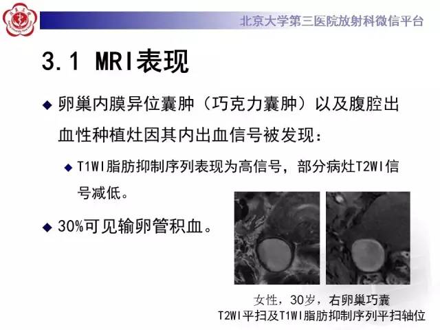 【病例】宫颈子宫内膜异位症(深部浸润型)1例MR
