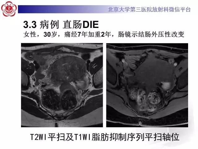 【病例】宫颈子宫内膜异位症(深部浸润型)1例MR