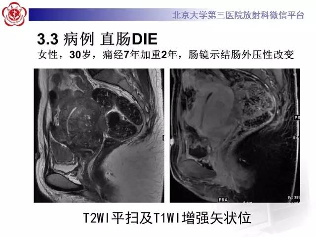 【病例】宫颈子宫内膜异位症(深部浸润型)1例MR
