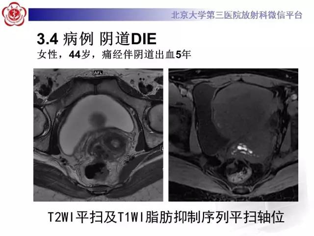 【病例】宫颈子宫内膜异位症(深部浸润型)1例MR
