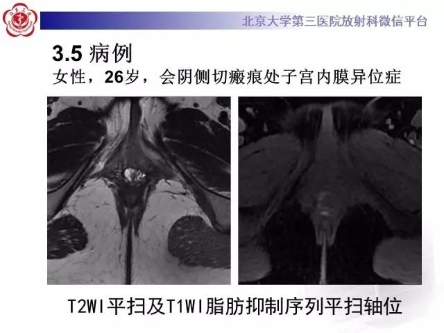 【病例】宫颈子宫内膜异位症(深部浸润型)1例MR