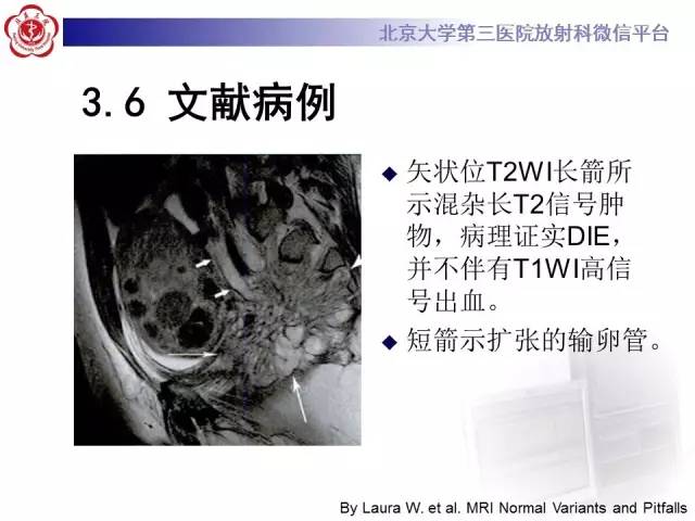 【病例】宫颈子宫内膜异位症(深部浸润型)1例MR