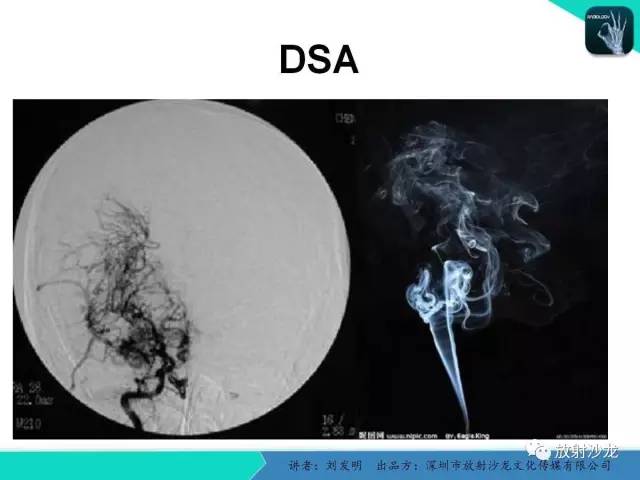 【PPT】浅析烟雾病的影像诊断