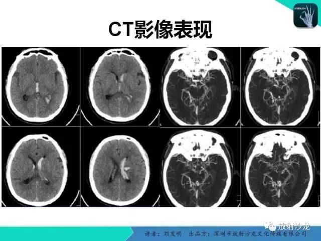 【PPT】浅析烟雾病的影像诊断