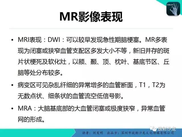 【PPT】浅析烟雾病的影像诊断