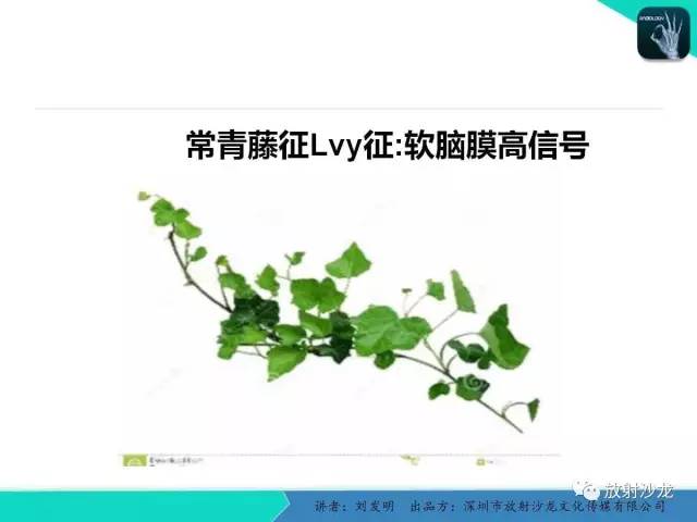 【PPT】浅析烟雾病的影像诊断