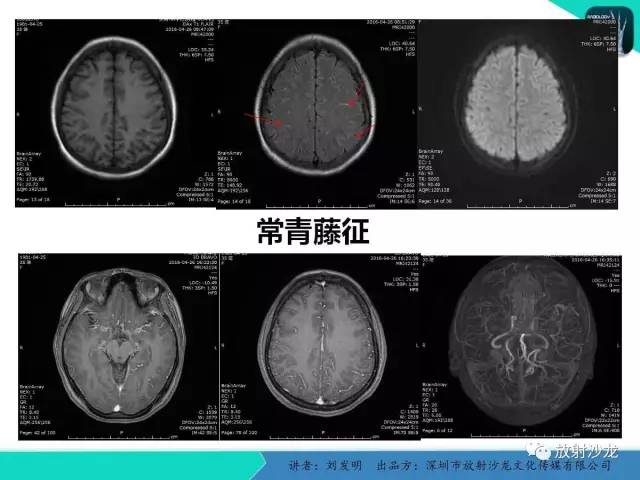 【PPT】浅析烟雾病的影像诊断