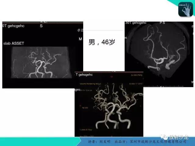 【PPT】浅析烟雾病的影像诊断
