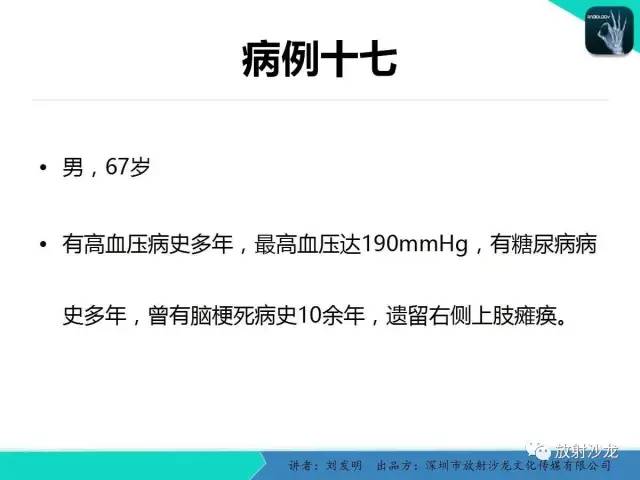 【PPT】浅析烟雾病的影像诊断