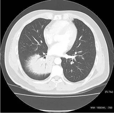【病例】肺粘膜相关淋巴组织淋巴瘤1例CT