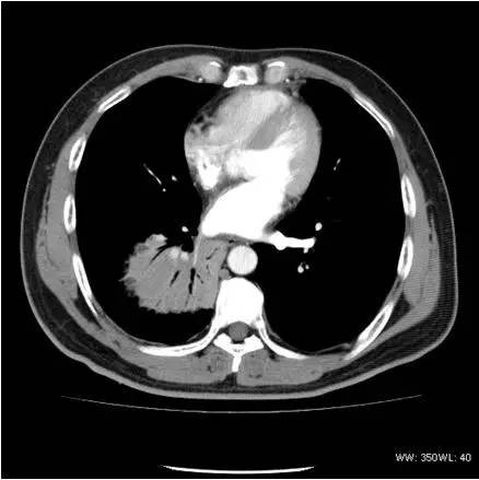 【病例】肺粘膜相关淋巴组织淋巴瘤1例CT