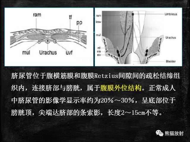 【PPT】脐尿管畸形与脐尿管癌的CT表现