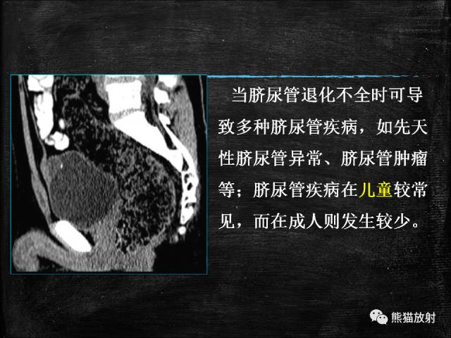 【PPT】脐尿管畸形与脐尿管癌的CT表现