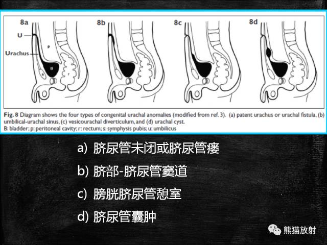 【PPT】脐尿管畸形与脐尿管癌的CT表现