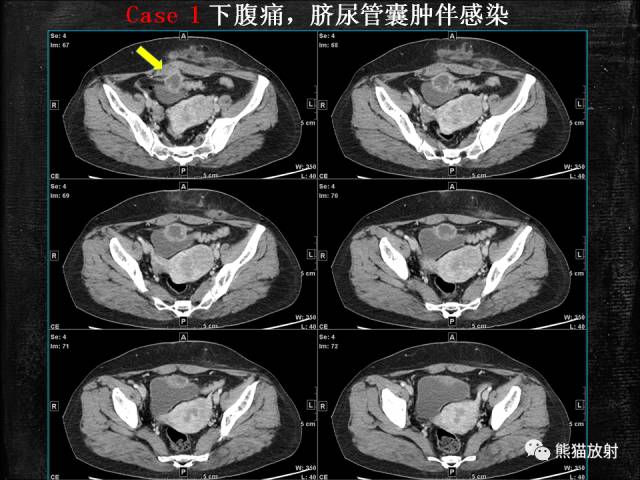 【PPT】脐尿管畸形与脐尿管癌的CT表现