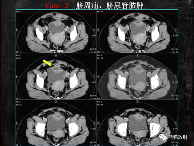 【PPT】脐尿管畸形与脐尿管癌的CT表现