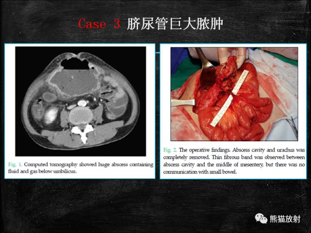 【PPT】脐尿管畸形与脐尿管癌的CT表现