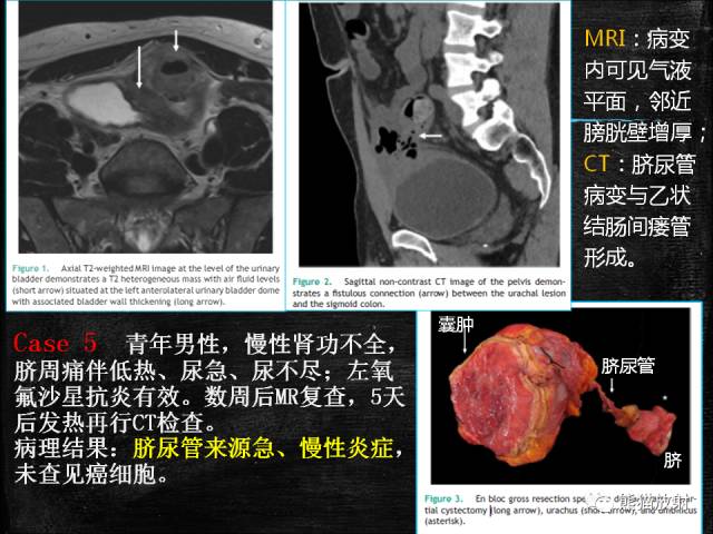 【PPT】脐尿管畸形与脐尿管癌的CT表现