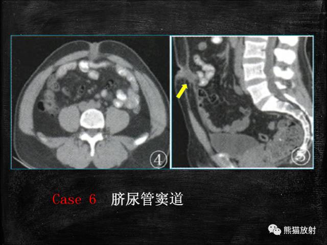 【PPT】脐尿管畸形与脐尿管癌的CT表现
