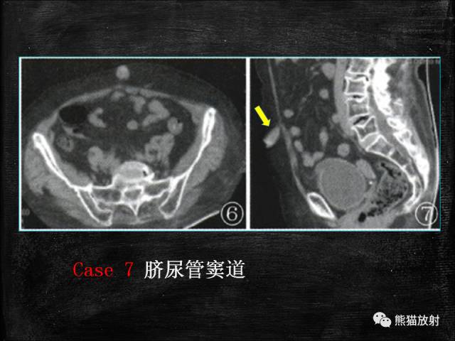 【PPT】脐尿管畸形与脐尿管癌的CT表现