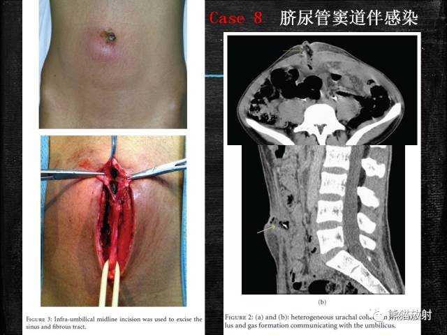 【PPT】脐尿管畸形与脐尿管癌的CT表现