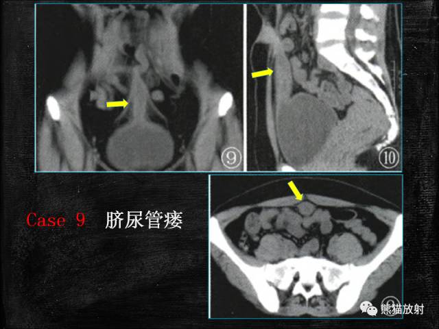 【PPT】脐尿管畸形与脐尿管癌的CT表现