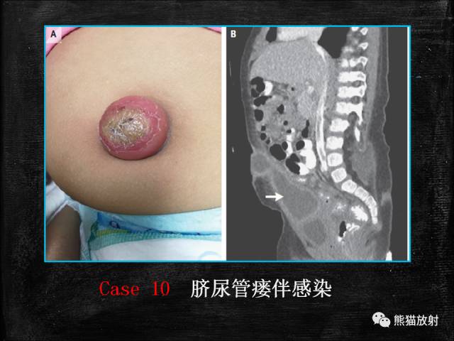 【PPT】脐尿管畸形与脐尿管癌的CT表现