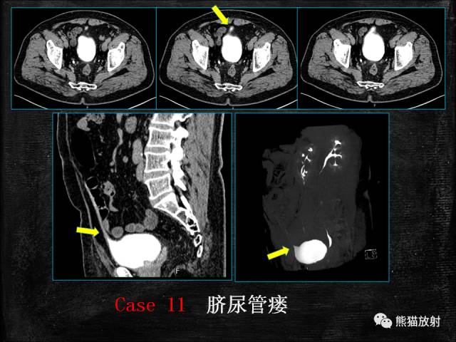 【PPT】脐尿管畸形与脐尿管癌的CT表现
