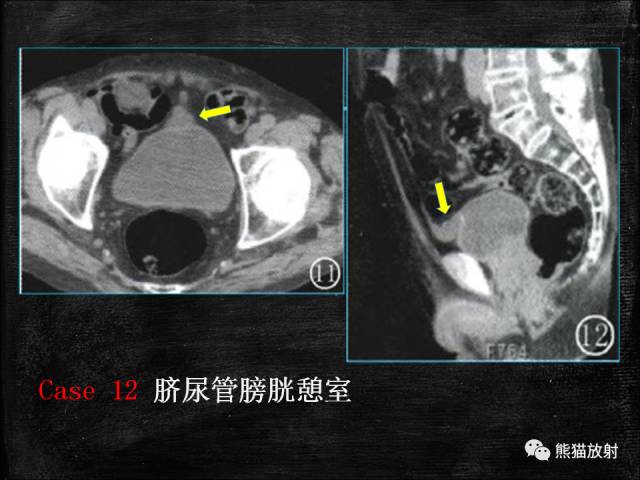 【PPT】脐尿管畸形与脐尿管癌的CT表现