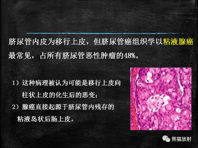 【PPT】脐尿管畸形与脐尿管癌的CT表现