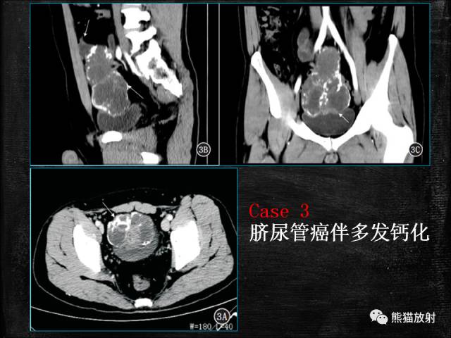 【PPT】脐尿管畸形与脐尿管癌的CT表现