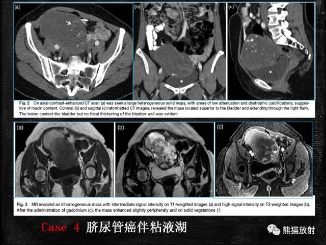 【PPT】脐尿管畸形与脐尿管癌的CT表现
