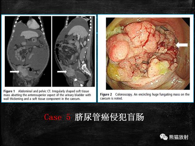 【PPT】脐尿管畸形与脐尿管癌的CT表现