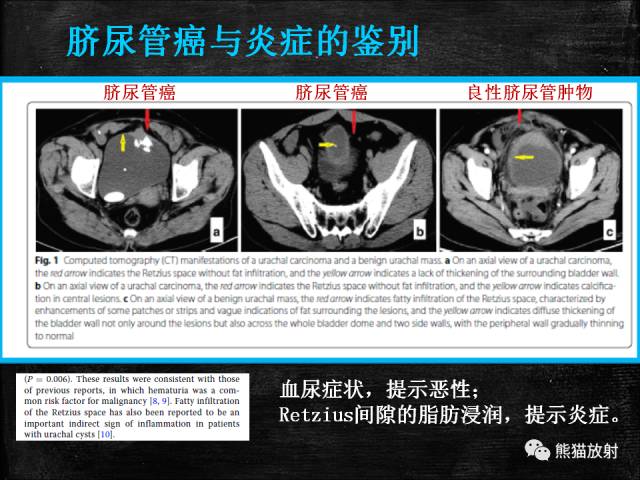 【PPT】脐尿管畸形与脐尿管癌的CT表现