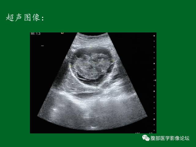 【病例】肝神经鞘瘤二例CT及MR 【病例】肝神经鞘瘤二例CT及MR
