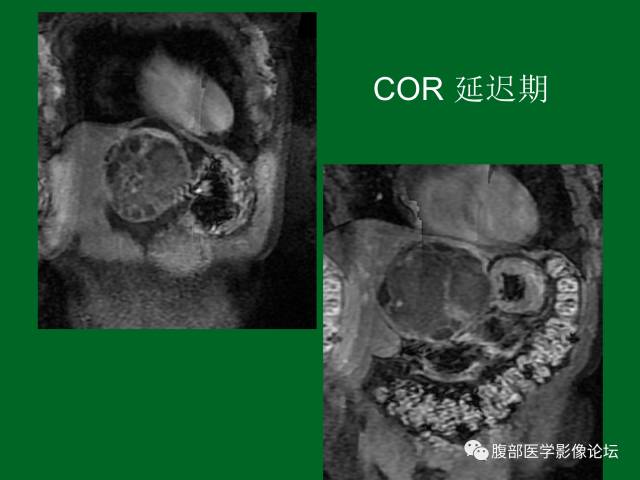 【病例】肝神经鞘瘤二例CT及MR 【病例】肝神经鞘瘤二例CT及MR