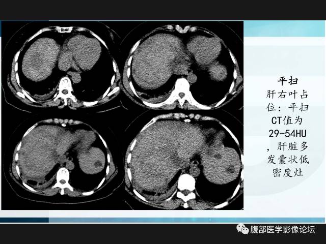 【病例】肝神经鞘瘤二例CT及MR 【病例】肝神经鞘瘤二例CT及MR