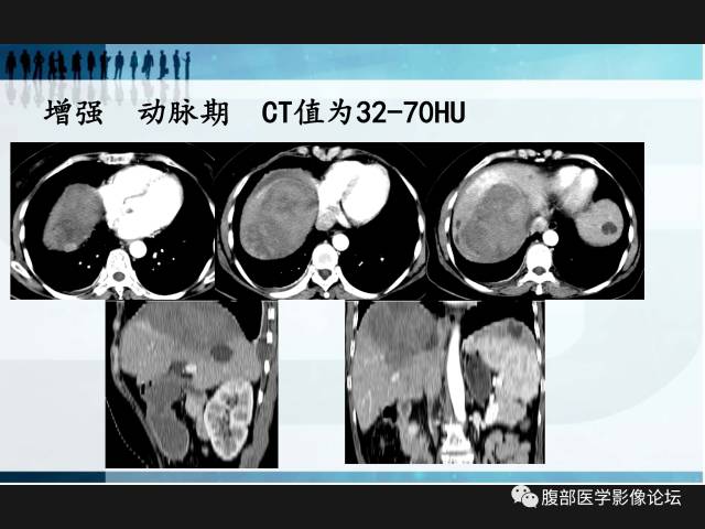 【病例】肝神经鞘瘤二例CT及MR 【病例】肝神经鞘瘤二例CT及MR