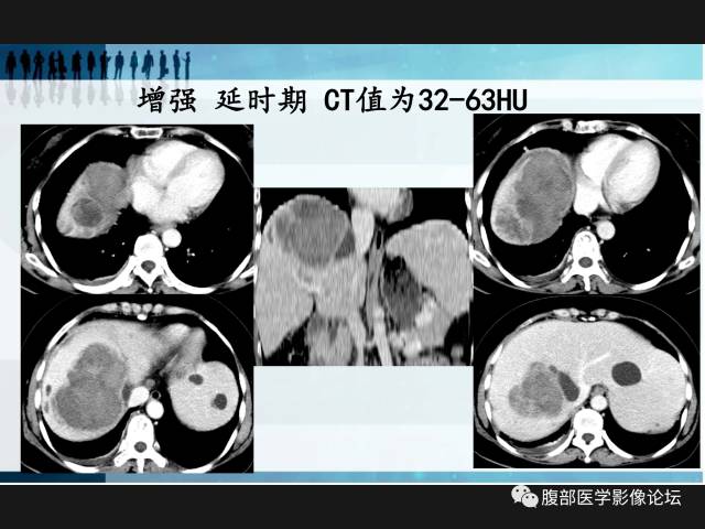 【病例】肝神经鞘瘤二例CT及MR 【病例】肝神经鞘瘤二例CT及MR