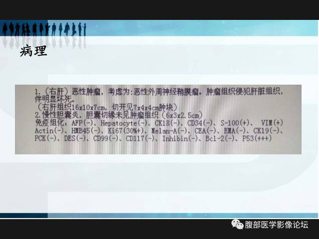 【病例】肝神经鞘瘤二例CT及MR 【病例】肝神经鞘瘤二例CT及MR
