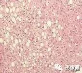 【病例】脂肪肝1例CT影像诊断分析 【病例】脂肪肝1例CT影像诊断分析