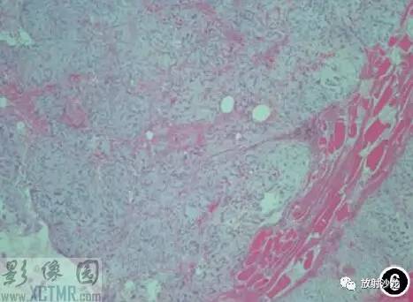 【病例】骨外黏液样软骨肉瘤1例MR影像表现