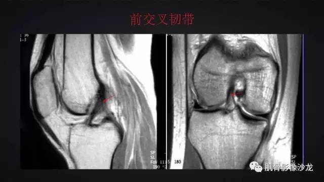 【PPT】膝关节解剖和半月板损伤影像解读