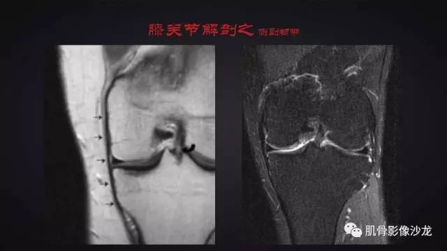【PPT】膝关节解剖和半月板损伤影像解读