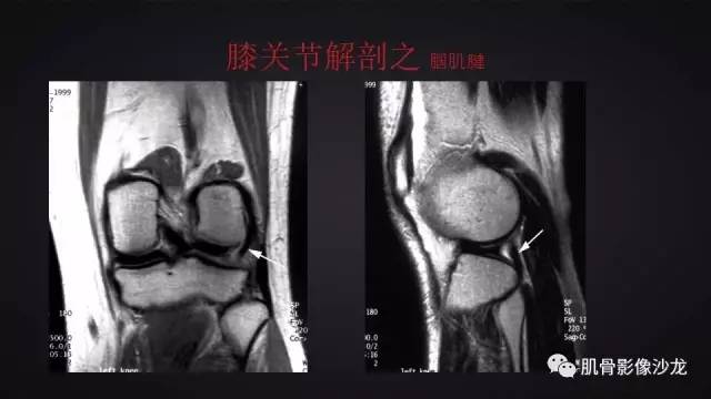 【PPT】膝关节解剖和半月板损伤影像解读