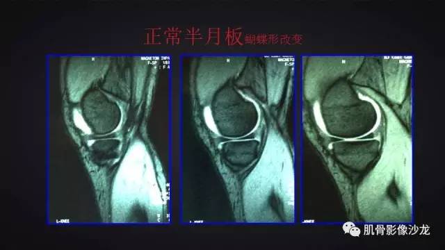 【PPT】膝关节解剖和半月板损伤影像解读